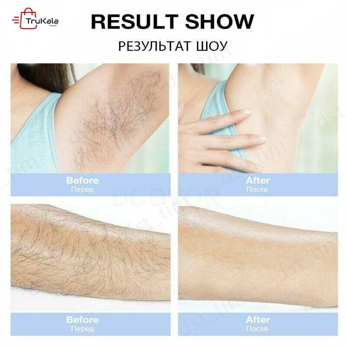 دستگاه لیزر خانگی حذف موهای زائد 900 هزار شات AM001 5 دستگاه لیزر خانگی حذف موهای زائد 900 هزار شات AM001 - تصویر 5